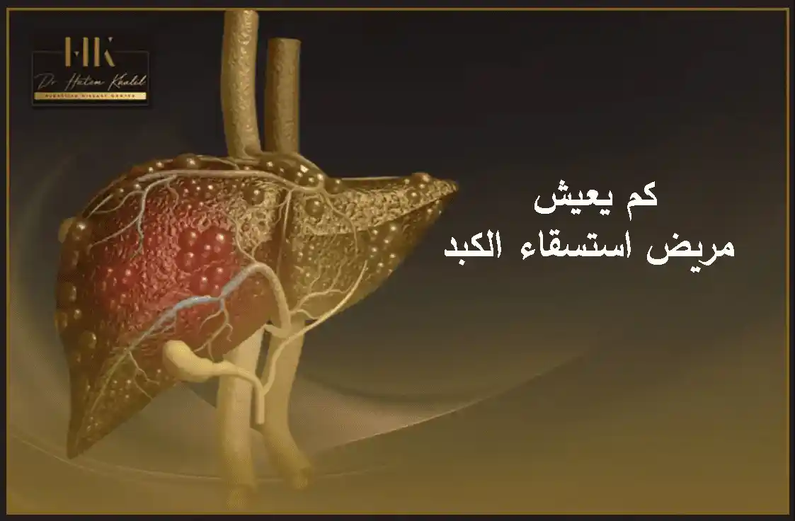 كم يعيش مريض استسقاء الكبد