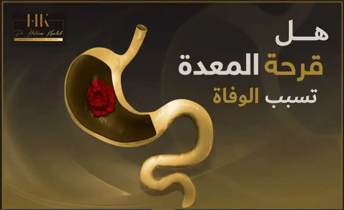 هل قرحة المعدة تسبب الوفاة ؟ المضاعفات وطرق الوقاية