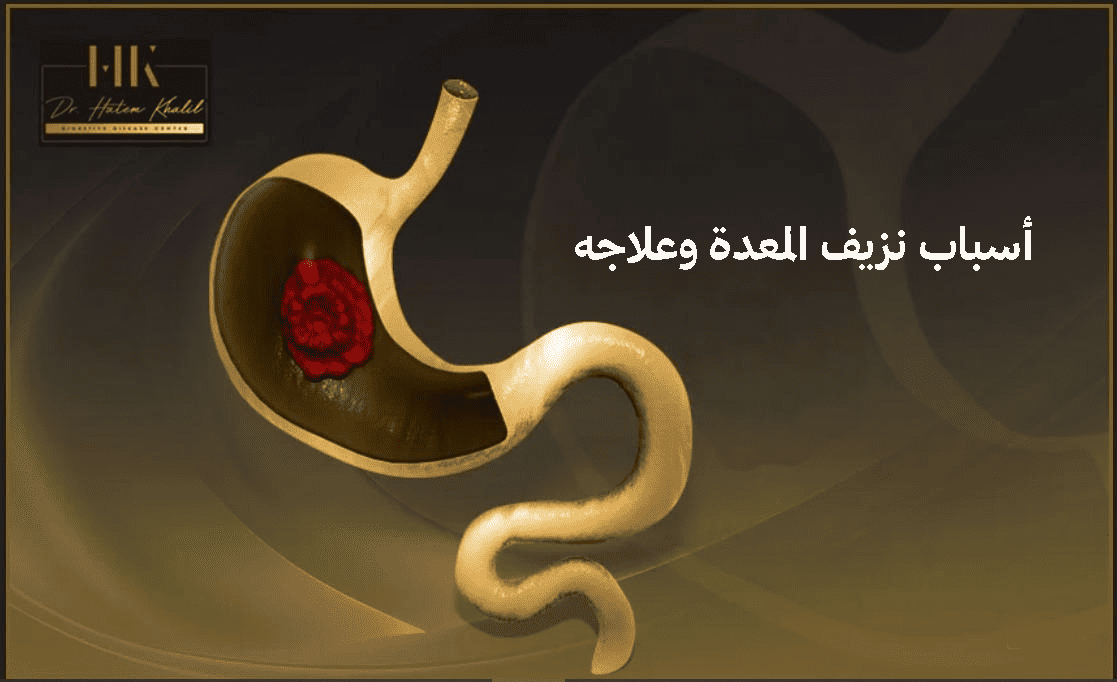 أسباب نزيف المعدة وعلاجه